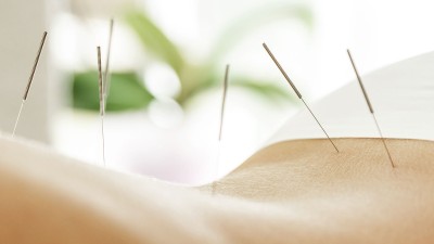 Akupunkturnadeln im Rücken