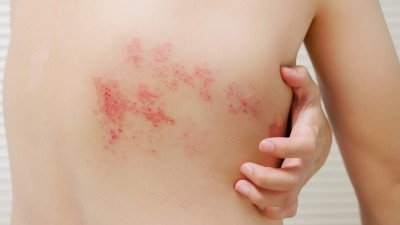 Der Rücken eines Mannes mit Gürtelrose. Er versucht, sich mit einer Hand an den roten Bläschen zu kratzen.