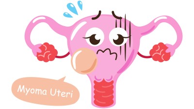 Ein Uterus-Cartoon mit einem Myom.